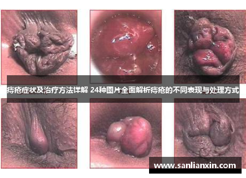 痔疮症状及治疗方法详解 24种图片全面解析痔疮的不同表现与处理方式
